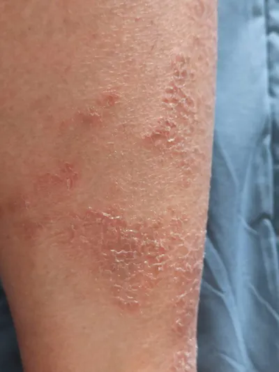 濕疹-食療綠豆湯(有雷,吃飯不要看)