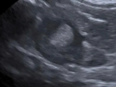 腫大的腎上腺型態