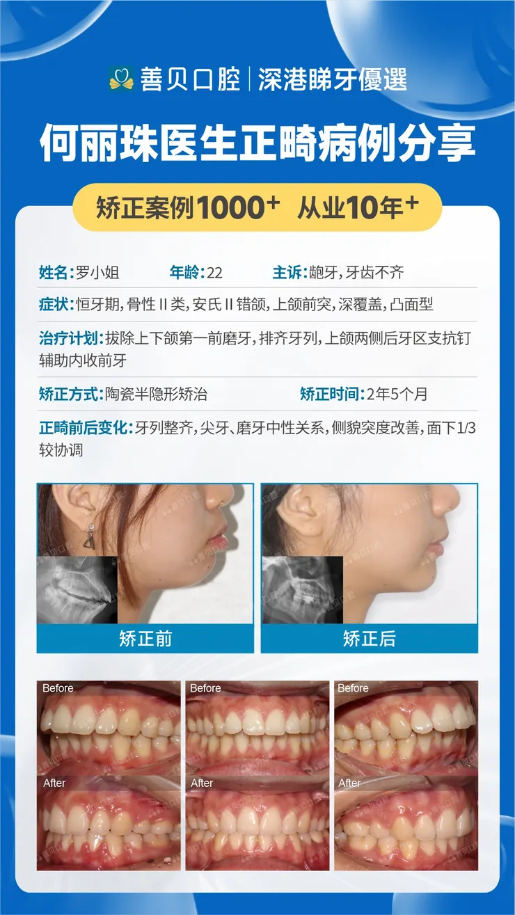 面部同口內箍牙對比