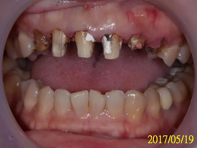 有圖有真相，令人震驚與難過的真相，這就是我常說的一翻兩瞪眼，像在『拆禮物』，沒拆開前永遠不知道真相左上爛牙齦發炎知道原因了，原來是爛到斷頭的牙根，之後還要先修牙齦（下詳）