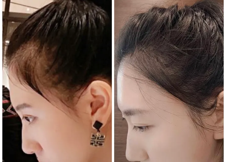 左邊是我以前側邊真的很可怕,對比現在真的有差