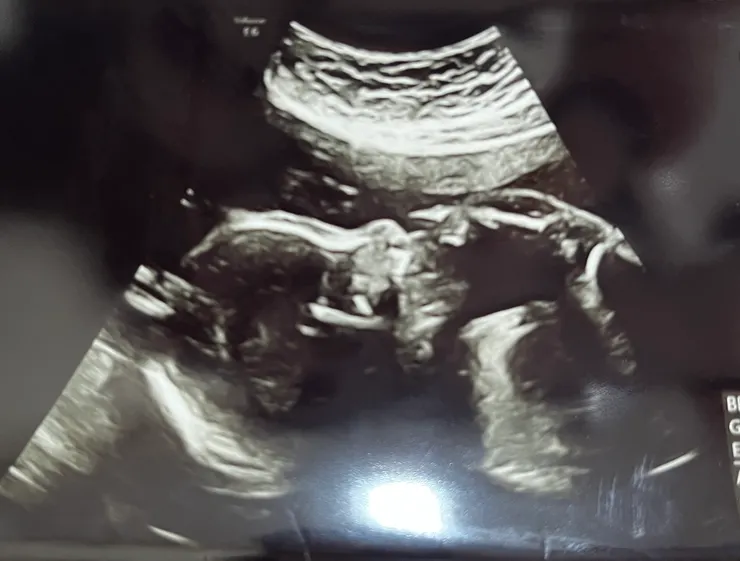 孕期中拍攝的超音波:腳放到臉上