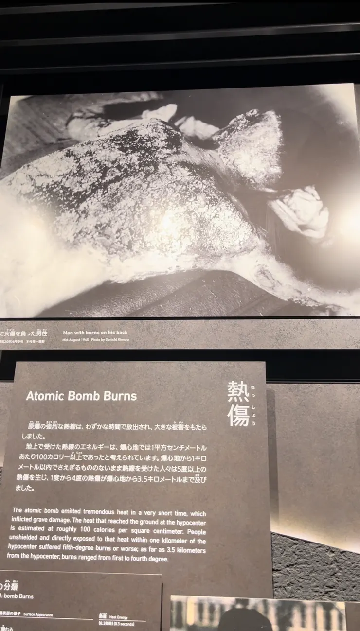 被強大熱線嚴重燒傷的被爆者。