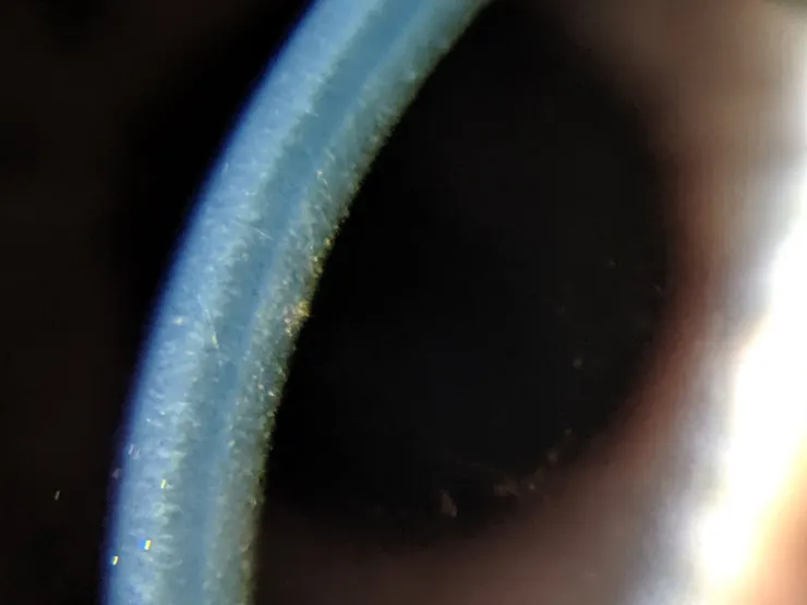 Fuchs氏失養症— Laser & Corneal Surgery Associates, PC