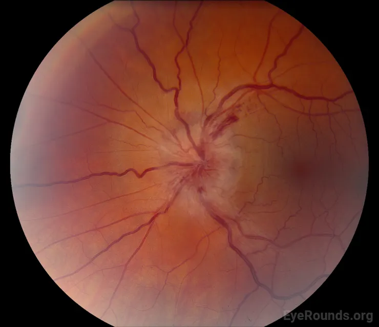 非動脈前缺血性視神經病變—eye round.org