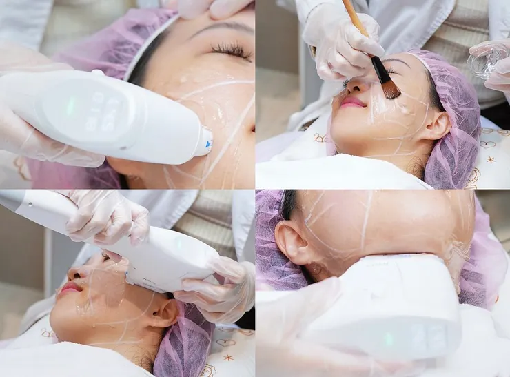 台北Z音波拉提推薦【板橋聖宜診所】終於找回緊緻V感,告別老