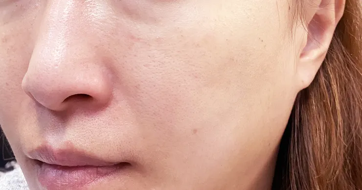 台北打皮秒│探索皮秒+蜂巢(超級鏡片ReFIX)-台北醫美診所推薦