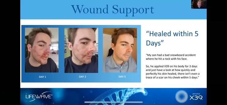 支持傷口復原：5天內的修復 “我兒子”滑雪跌倒, 臉撞到石頭, 使用X39 3天明顯改善, 5天內已經看不太出來受傷處