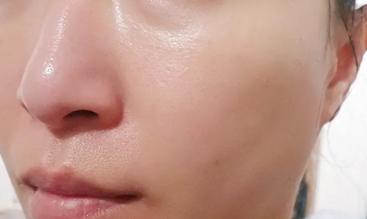 台北打皮秒│探索皮秒+蜂巢(超級鏡片ReFIX)-台北醫美診所推薦