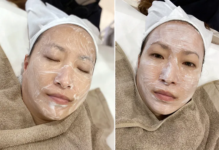 台北打皮秒│探索皮秒+蜂巢(超級鏡片ReFIX)-台北醫美診所推薦