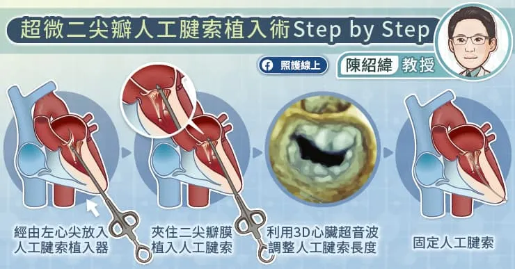 超微創二尖瓣人工腱索植入術