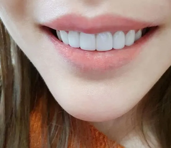 維港口腔瓷牙貼片效果