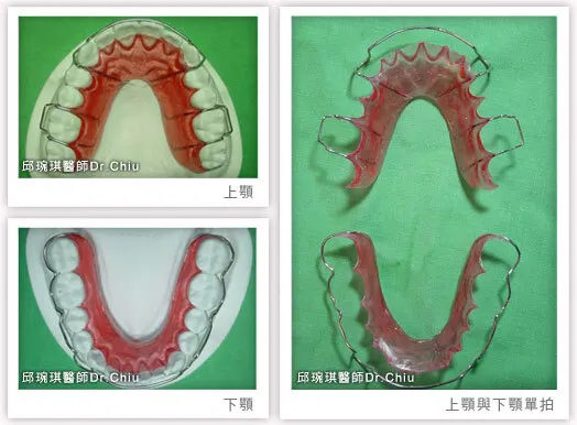 上顎維持器是Hewley's retainer，下顎維持器是wrap around retainer（詳細介紹在文末FAQ 2）此為邱醫師的個人習慣，通常上下形式都一樣 ，