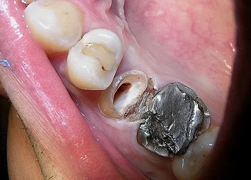 渥爾牙醫診所:斜裂小臼齒修復案例!Cap-Lock全瓷系列的完美應用(案例一)