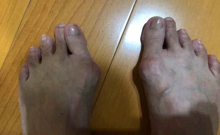 圖二:邱大媽0514日腳踝重疊改善