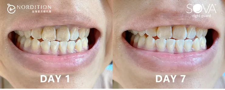 SOVA®專業療程居家牙齒美白凝膠組▂ 使用對比