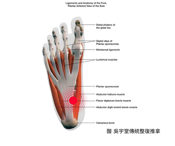 足底筋膜炎好發位置