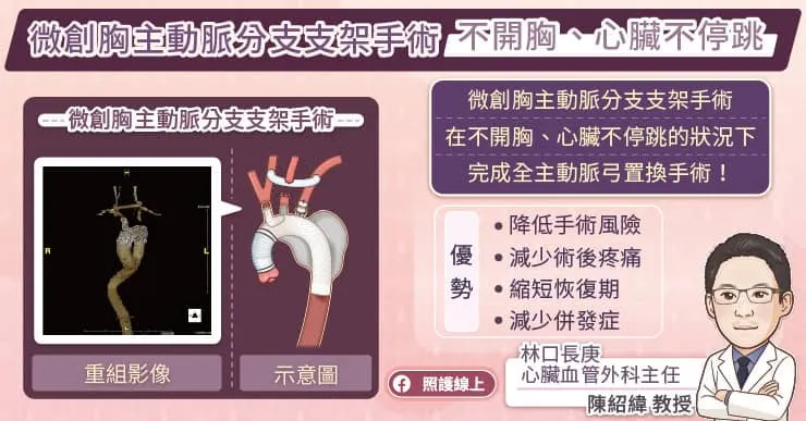 微創胸主動脈分支支架手術不開胸、心臟不停跳