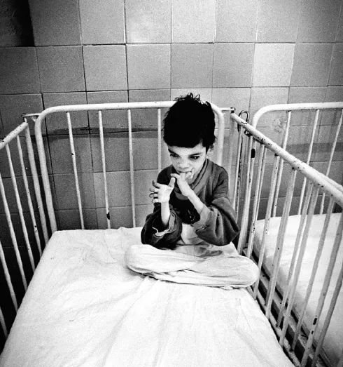 1980年羅馬尼亞安置機構的小孩, 受到嚴重忽視與剝奪,普遍低智商,自閉,憂鬱,焦慮,各腦區萎縮,唯杏仁核變大