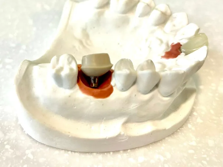 渥爾牙醫診所：植牙不只要穩，更要懂得「避震」！認識Bio-HPP新材料植體假牙