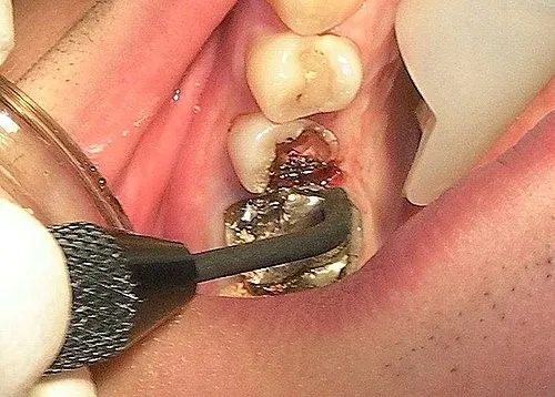 渥爾牙醫診所:斜裂小臼齒修復案例!Cap-Lock全瓷系列的完美應用(案例一)