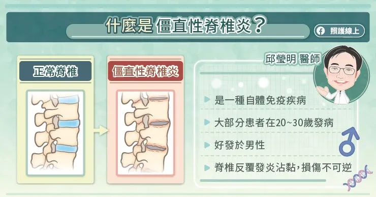 什麼是僵直性脊椎炎?