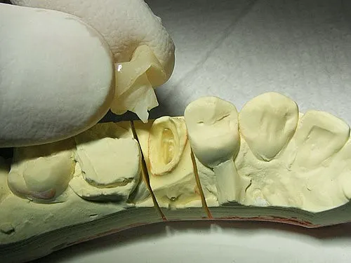 渥爾牙醫診所:斜裂小臼齒修復案例!Cap-Lock全瓷系列的完美應用(案例一)