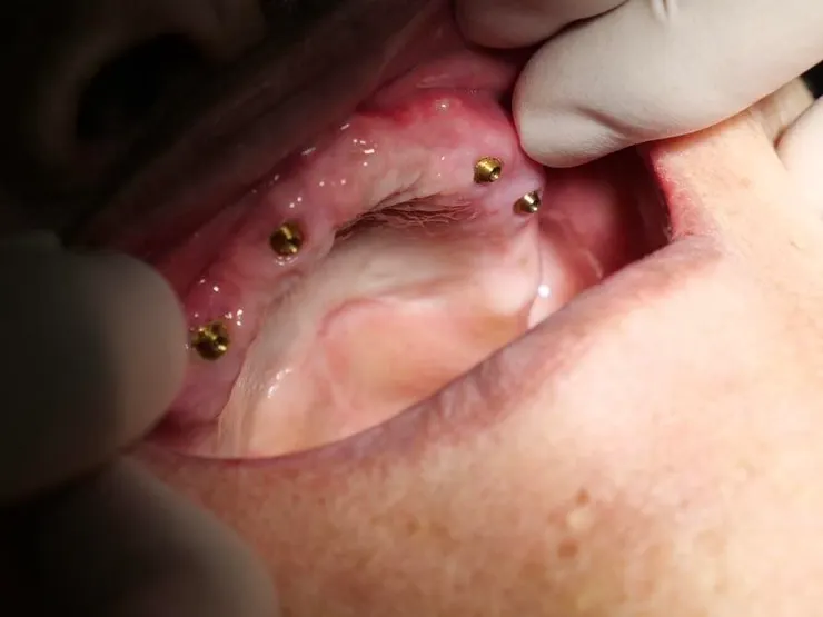 渥爾牙醫診所：All-on-4 全口重建個案成果報告！重新找回自信笑容的一天！