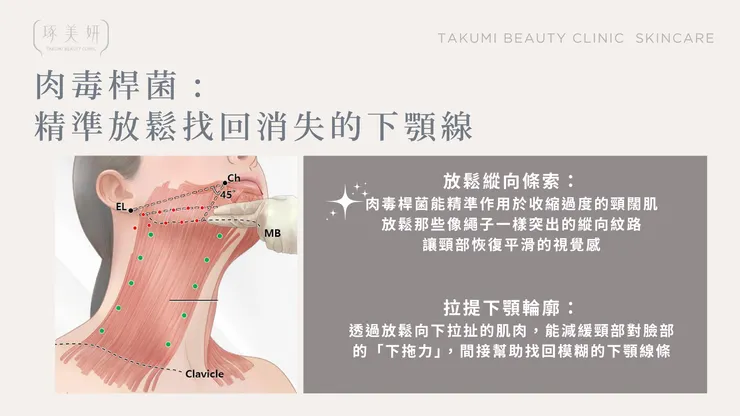 擺脫「火雞脖」！肉毒桿菌如何放鬆頸闊肌，重塑緊緻頸部線條