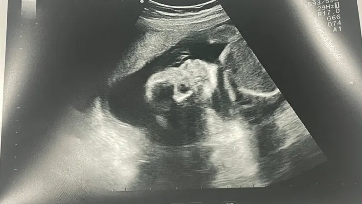 24週胎兒超音波影響/Ching拍攝