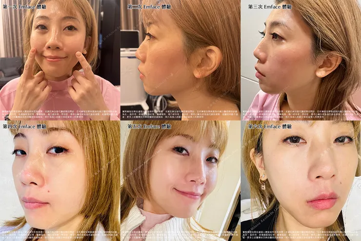 Emface療程全紀錄｜第1～6次術後變化照