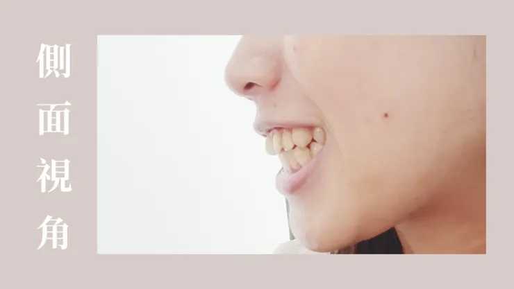 側面也看的到門牙有一點凸出來