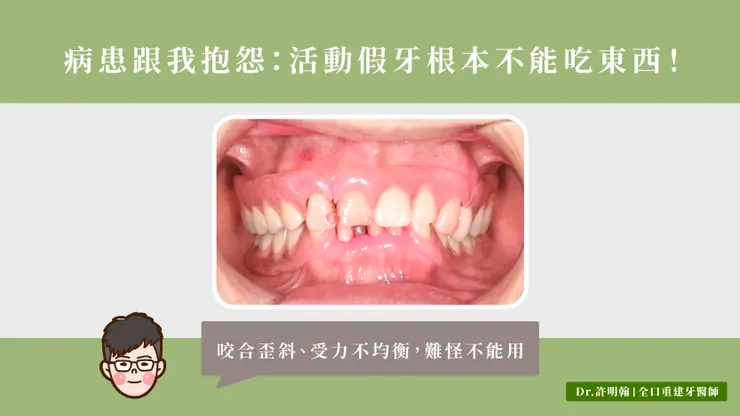 活動假牙不能吃東西？咬合歪斜、受力不均衡、假牙設計都有問題