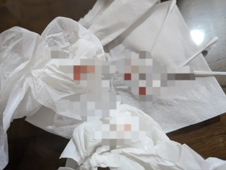 耳膜破裂出血，用了很多衛生紙跟棉花棒，才暫時止住。