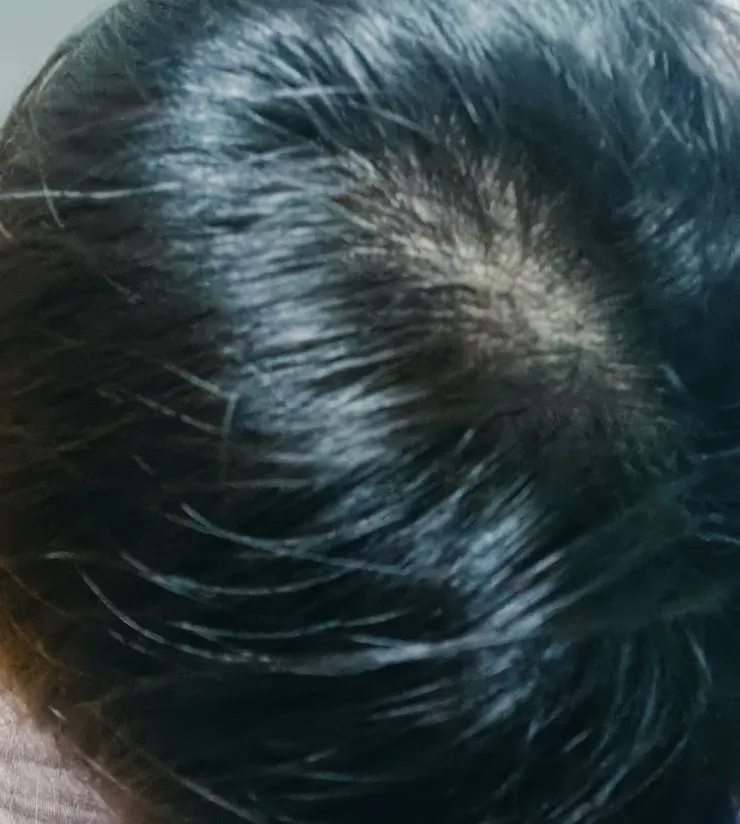 雖然還是有幾根白毛~但整體比之前好很多