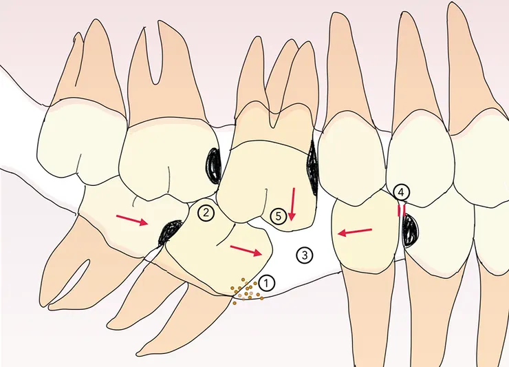 缺牙植牙優選善貝口腔