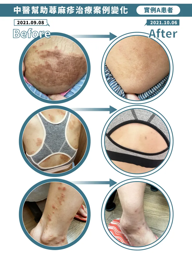 中醫幫助蕁麻疹治療案例變化-患者A