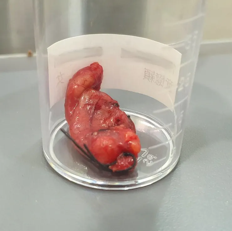 頸部切下來的腫塊（已部份引流）