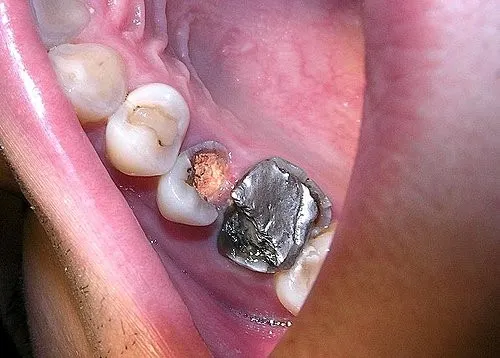 渥爾牙醫診所:斜裂小臼齒修復案例!Cap-Lock全瓷系列的完美應用(案例一)