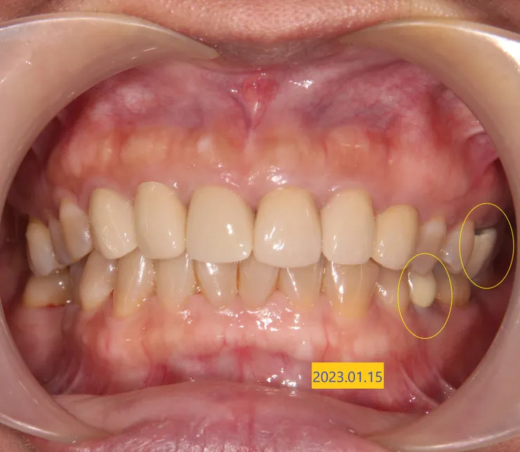 她有用音波牙刷潔牙，保持牙周健康，牙齦更飽滿了，假牙看起來更自然（可以跟她其他的金屬瓷牙比較）