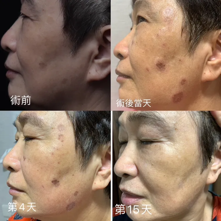 治療後15天