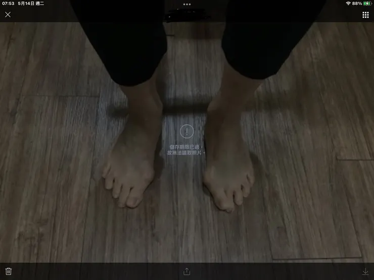 圖一:邱大媽0318日腳踝重疊