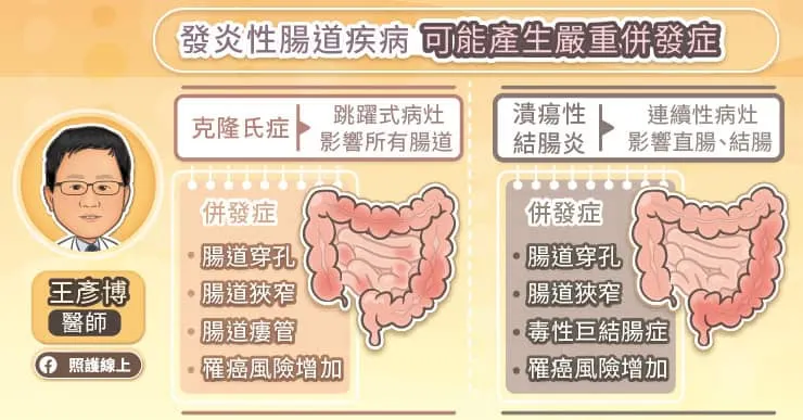 發炎性腸道疾病可能產生嚴重併發症