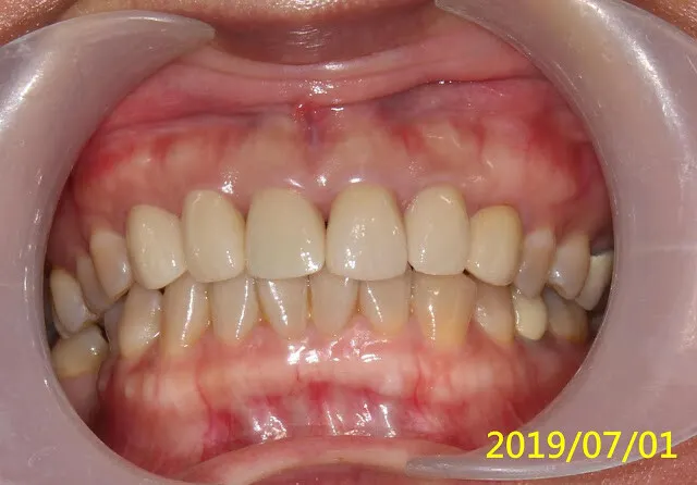再經過一年，假牙看起來更自然了，當初剛裝假牙時的牙齦，病人自己說大概一個多月就自動長好恢復了