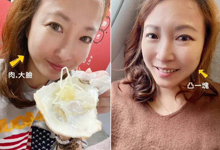 台北打雙下巴│ONDA超微波（昂達），台北醫美診所推薦【旭彤診所】