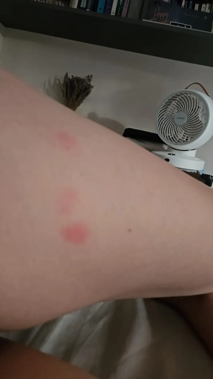 皮膚上明顯床蝨叮咬痕跡，紅腫發熱，看了都痛