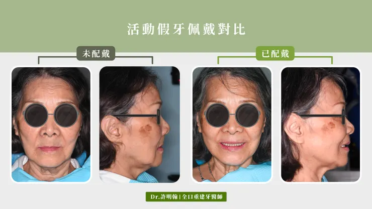 活動假牙配戴前後對比