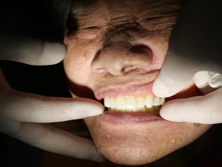 渥爾牙醫診所：All-on-4 全口重建個案成果報告！重新找回自信笑容的一天！