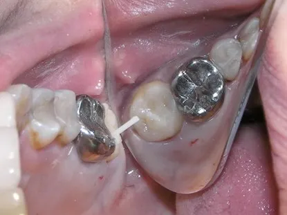 渥爾牙醫診所:蛀蝕深入牙肉下的修復挑戰!Cap-Lock全瓷系列拯救上顎第二大臼齒!