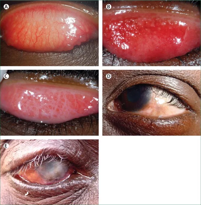 Trachoma—The Lancet 